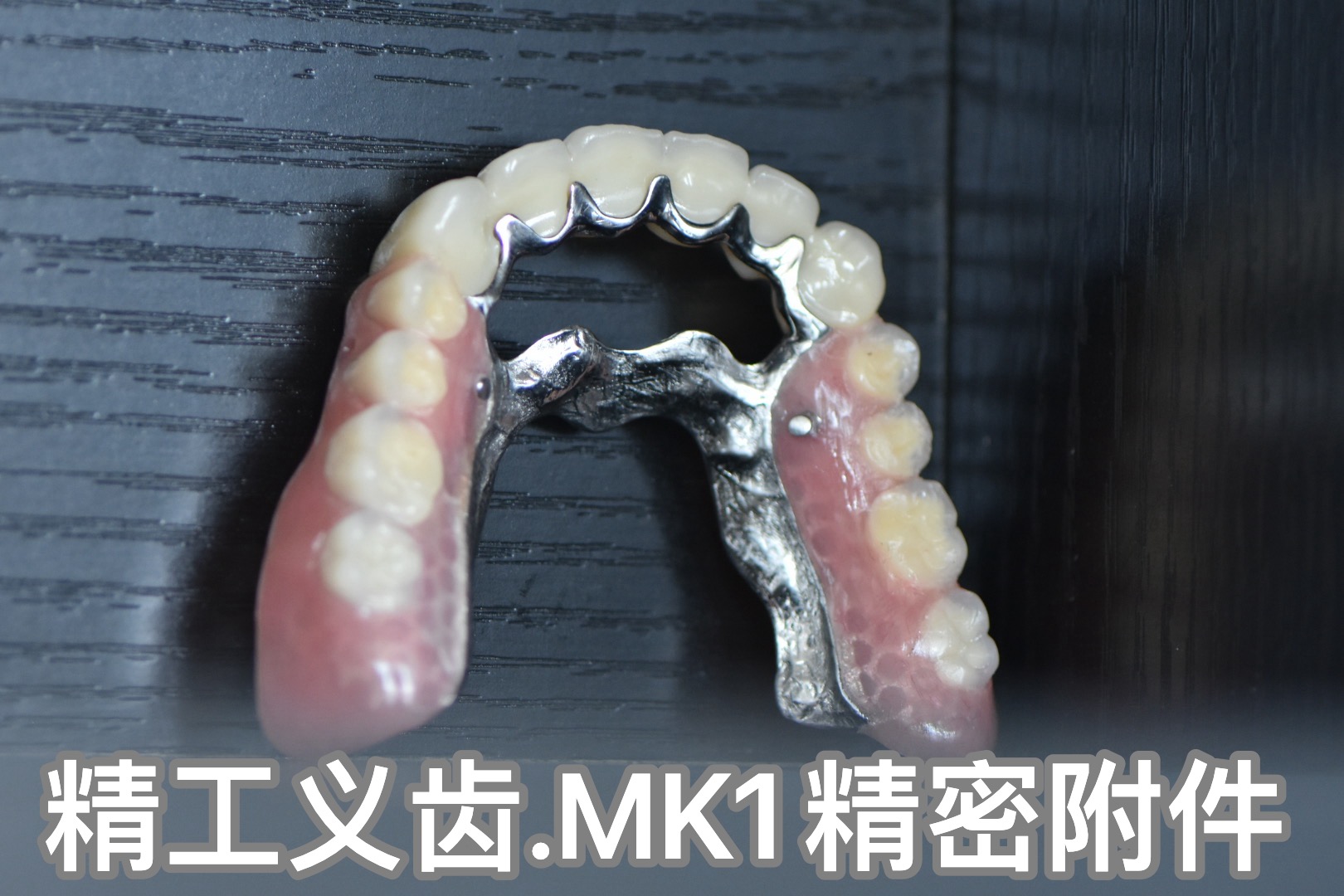 精工義齒-MK1精密附件